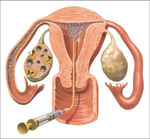 Az ovuláció stimulálása: a vizsgálatok, a jelzések, az eljárás jellemzői